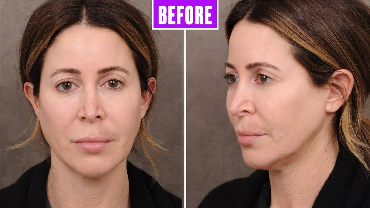 I Got a Facelift From Denise Richards’ Surgeon and Love My Results
