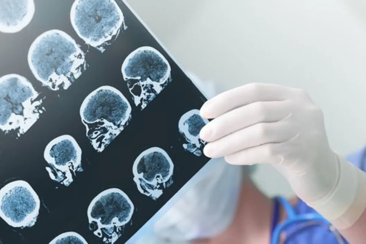 Parkinson: un especialista explicó cuál es el primer síntoma detectable
