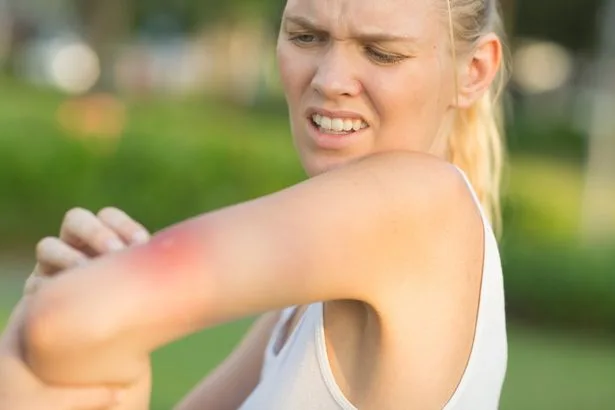 Heatwaves' sting in the tail as insect bites soar during hot weather
