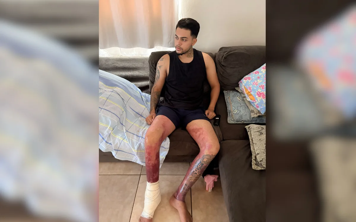 Jovem que teve queimaduras após explosão causada por etanol em tacho recebe alta de hospital: 'Tempo de recuperação'