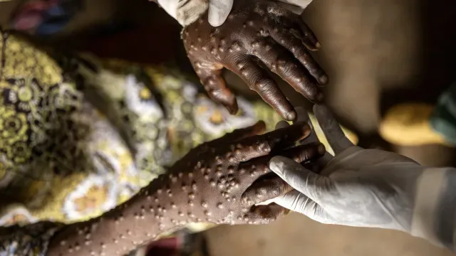 Angola regista 19 novos casos de mpox nas últimas 24 horas