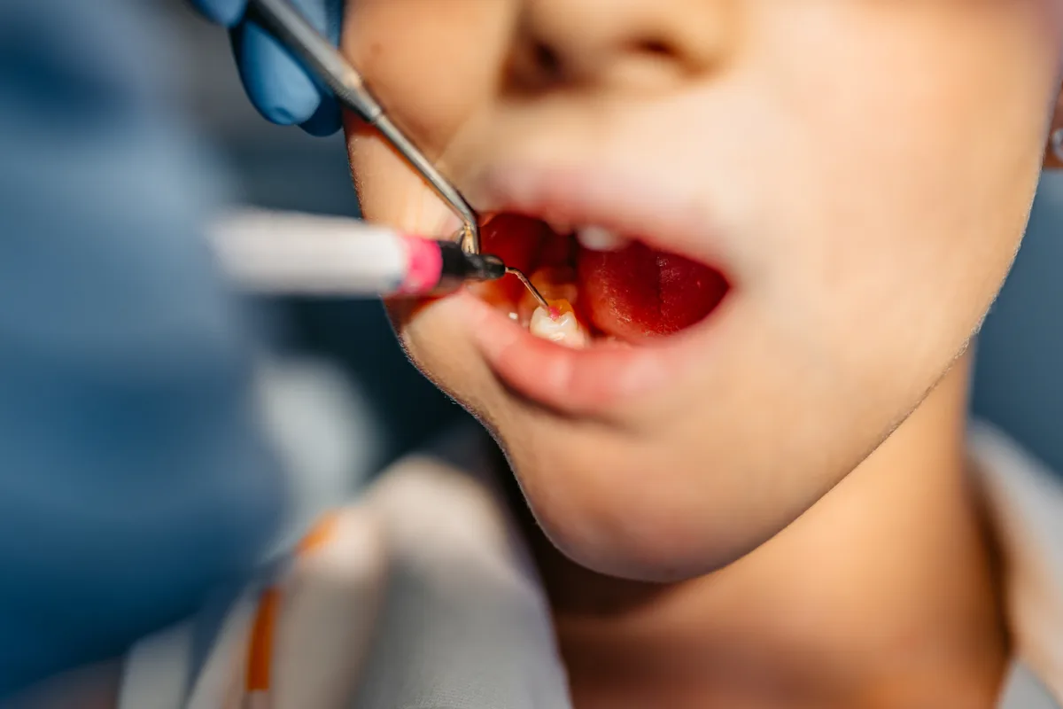 Crianças brasileiras vão ao dentista pela primeira vez só aos 7 anos, aponta levantamento