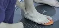 Seis de cada diez adultos tienen deformidades en los dedos de los pies sin saber que pueden prevenirse, según podólogos