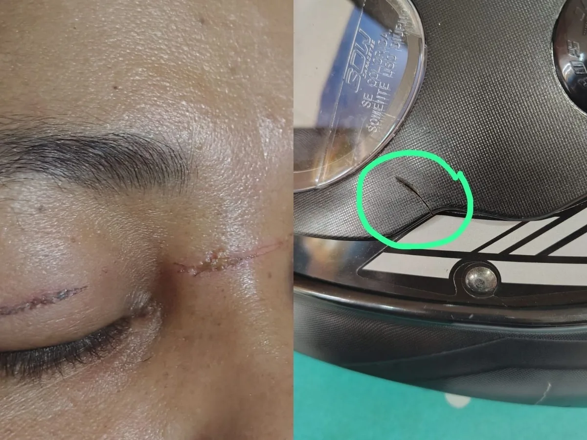 Diarista sofre cortes no rosto e pescoço por linha de pipa ao andar de moto no AC: 'Nasci de novo'