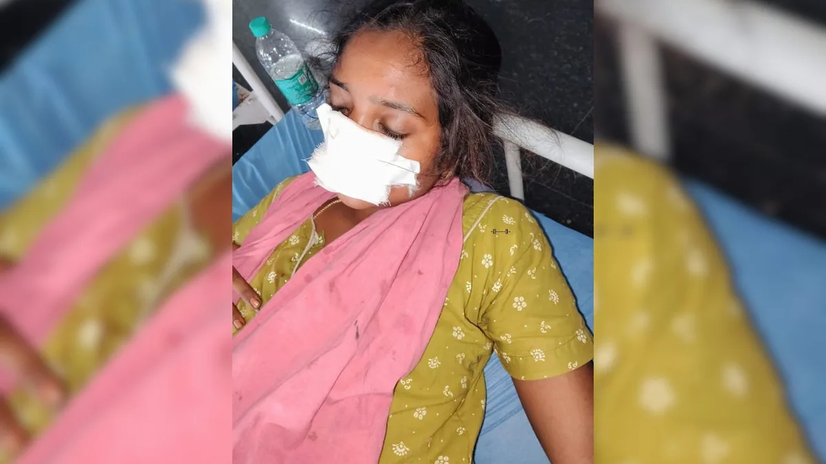 Telangana Man Bites Off Wife's Nose After She Refuses To Return Home