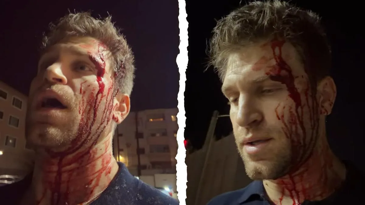 Keegan Allen: Pretty Little Liars actor shares bloody video after allegedly being robbed by armed attackers