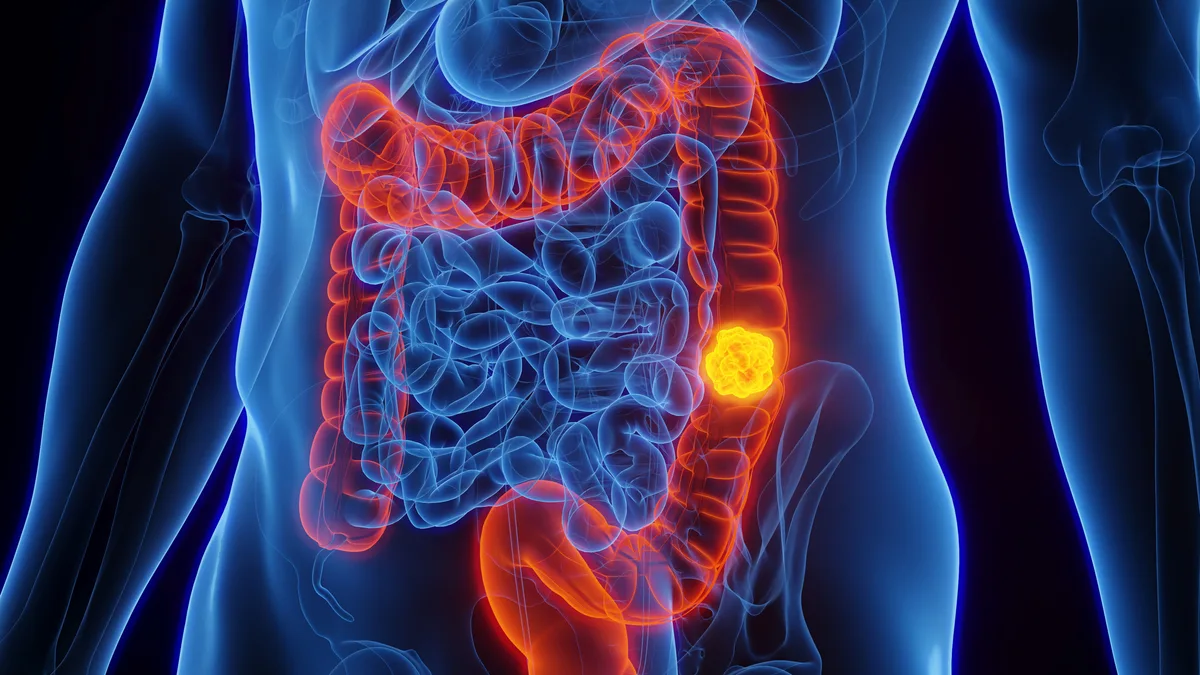Mudanças nas fezes podem indicar câncer de intestino; saiba os sinais