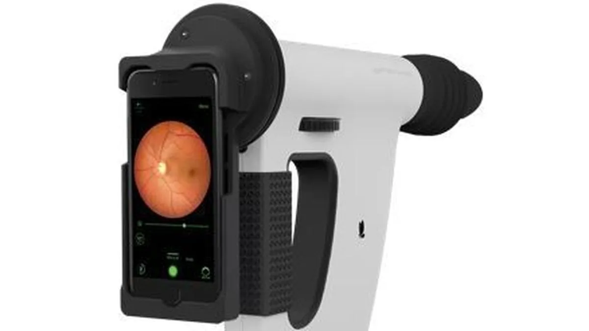 AI systems in smartphones may help detect eye diseases: study