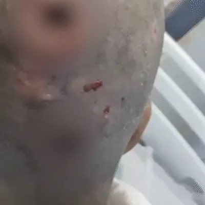 Mulher é resgatada com larvas na cabeça e polícia apura violência sexual