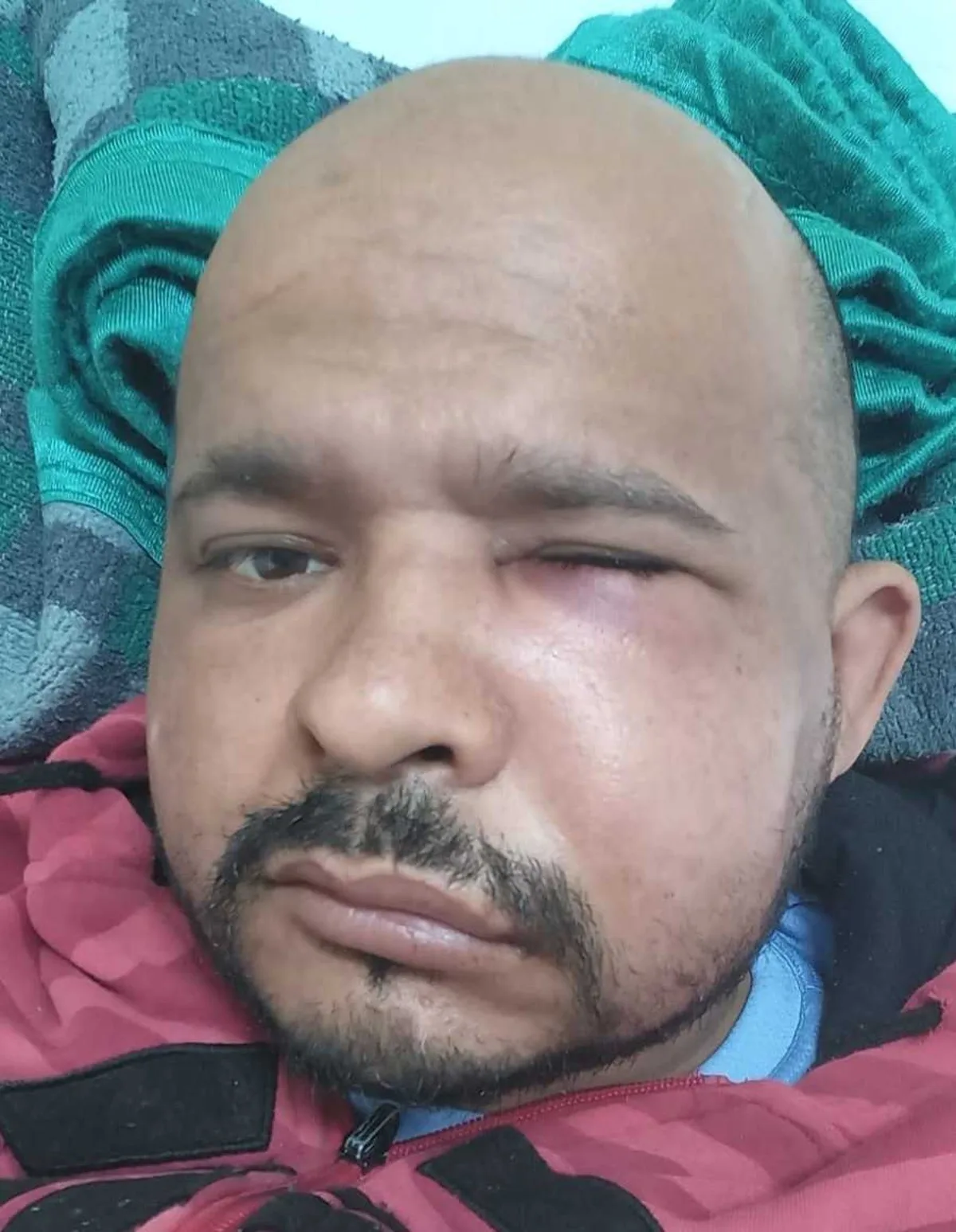 Árbitro agredido em jogo da várzea terá que passar por nova cirurgia: "Não consigo mastigar"