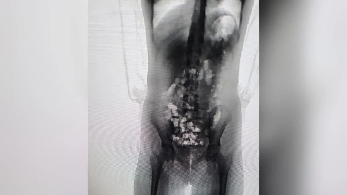 Mãe é detida após scanner corporal flagrar adolescente de 13 anos com 32 pacotes escondidos no corpo em SC