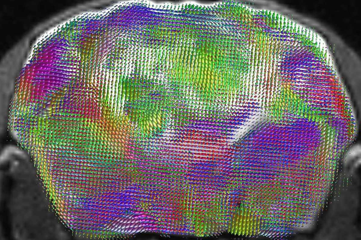 Científicos cultivaron tejido cerebral humano en ratones para estudiar trastornos neurológicos