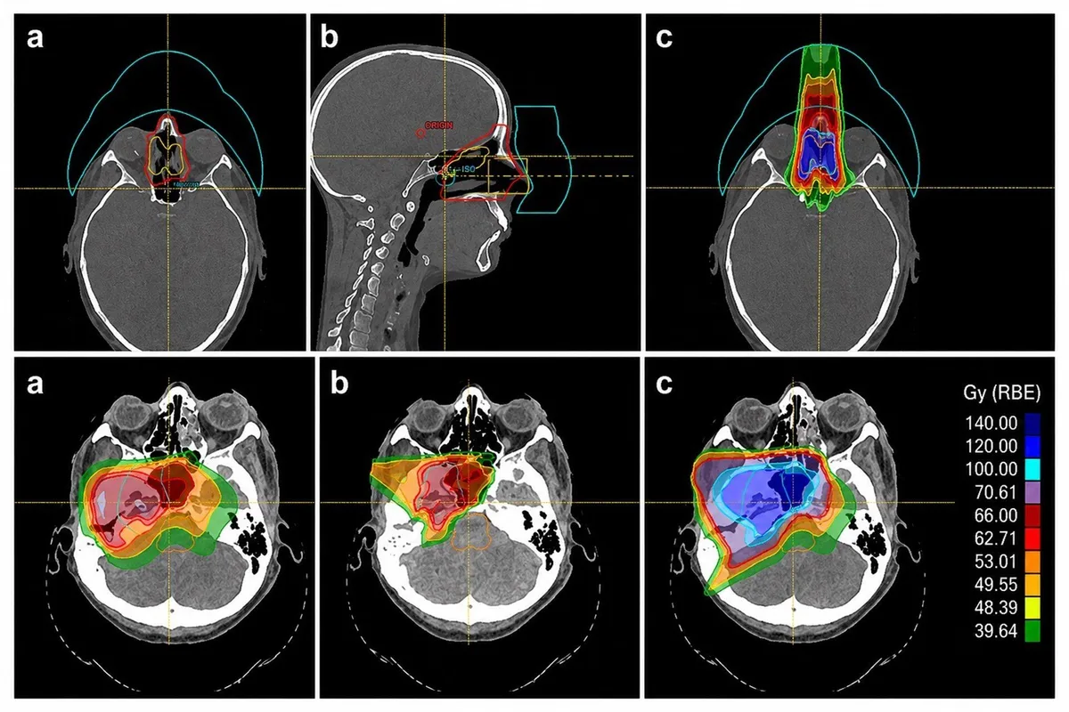 La reirradiación con protonterapia logra un 67% de supervivencia en cáncer de cabeza y cuello, según un estudio