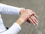 Why so many are suffering with weeping, crusty skin as autumn rolls in. I'm a top dermatologist whose life is blighted by eczema every year. This is how to soothe and erase it