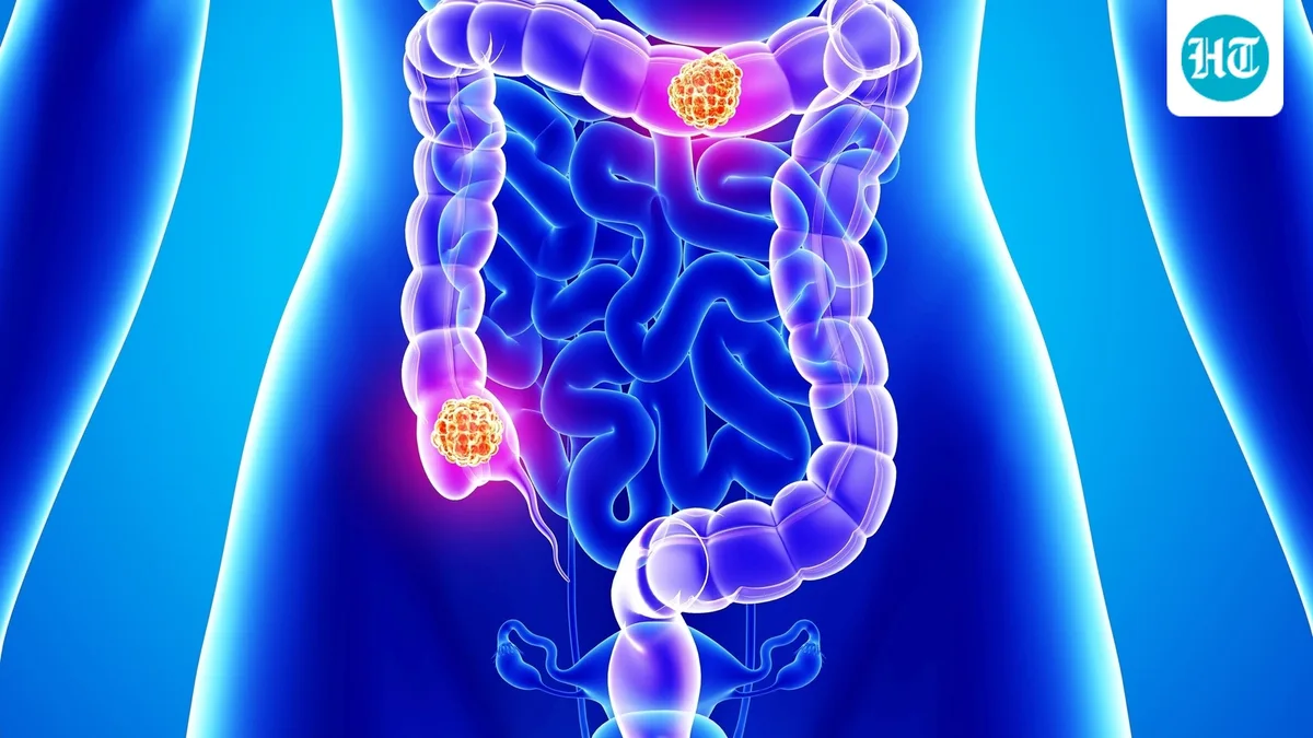 Could a gut ‘repair switch’ also help colorectal cancer spread? Oncologist shares what ZFP36L2 research reveals