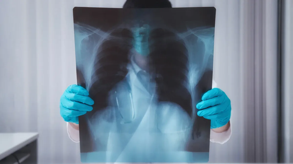 Avance en el cáncer de pulmón: hallan una señal clave para detectarlo a tiempo y saber si el tratamiento funcionará