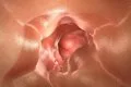 Un estudio confirma que retrasar de tres a cinco años la vigilancia tras adenomas avanzados es seguro
