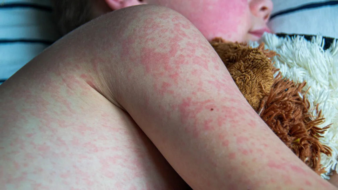 Two unvaccinated people die from measles in Pennsylvania, officials confirm