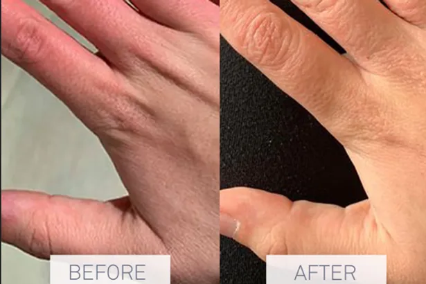 Dragons' Den nurse's 'incredible' £10 cream 'cleared up 10 years of hand psoriasis'
