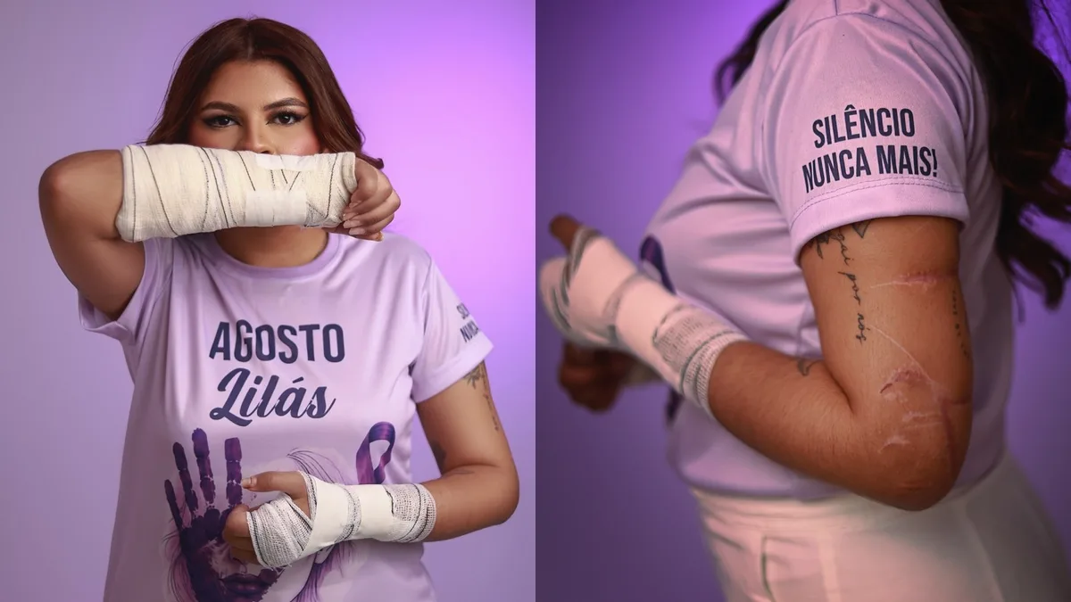 Jovem que teve as mãos decepedas em tentativa de feminicídio passará por nova cirurgia para acelerar recuperação e sonha em ser advogada