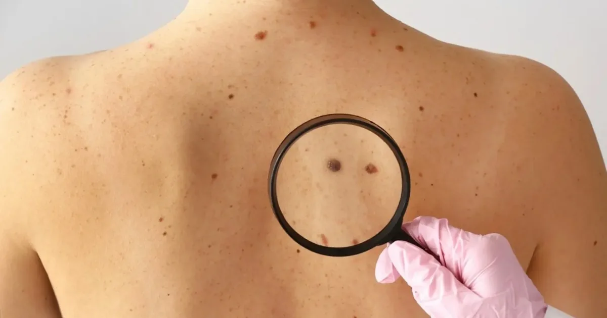 Hito en la medicina: la primera vacuna de ARN contra el cáncer de piel supera con éxito la fase final