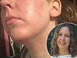 I was horrified to wake up with swollen eyes and angry red patches on my face and neck. I spent £700 on 'miracle treatments' and couldn't leave the house. This £16.50 solution finally cleared my skin without medication