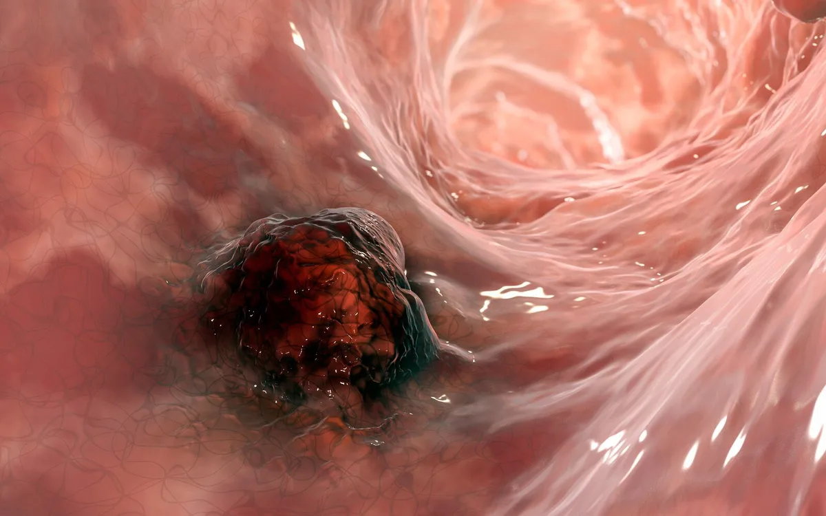 Cancro do intestino “derreteu” após imunoterapia — e não regressou