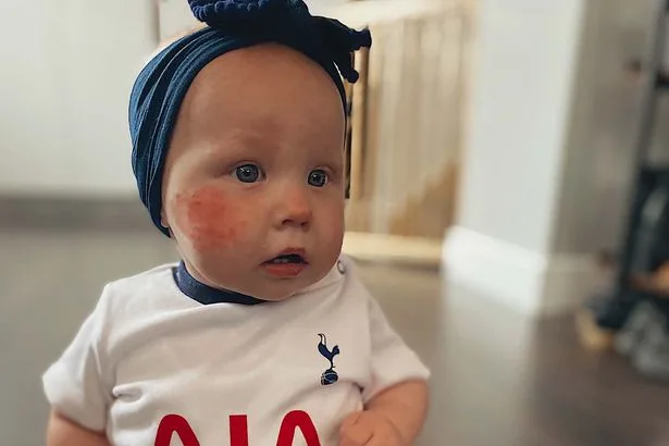 Everyone said I was worrying over baby’s rash but 8 months later she was gone
