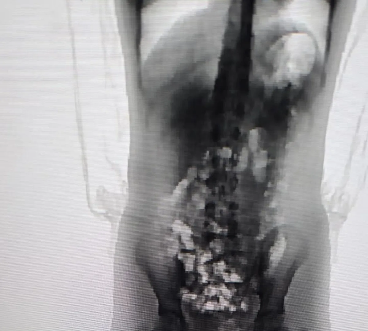 Scanner corporal flagra adolescente de 13 anos com droga dentro do corpo em presídio de Chapecó
