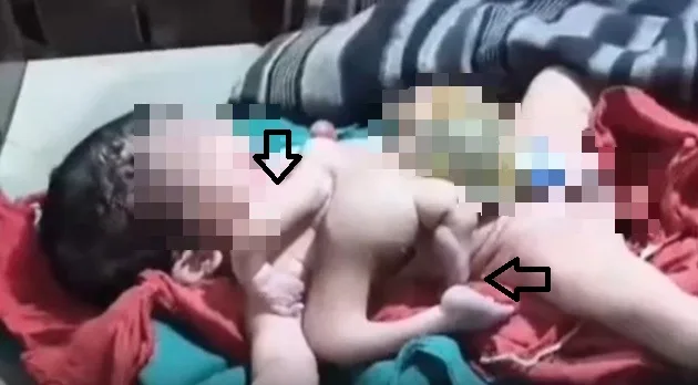 인도에서 ‘팔 4개·다리 4개’ 아기 태어나… 어떻게 된 일일까?