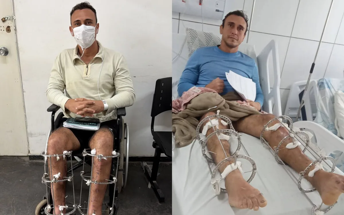 Paciente encontra larvas em ferida na perna enquanto aguarda por cirurgia no Hospital da Restauração