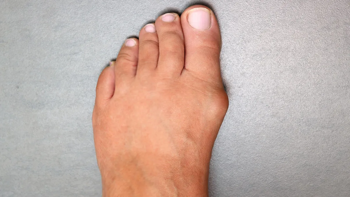 Hallux valgus: Ursachen für den Schmerz, Behandlung und OP