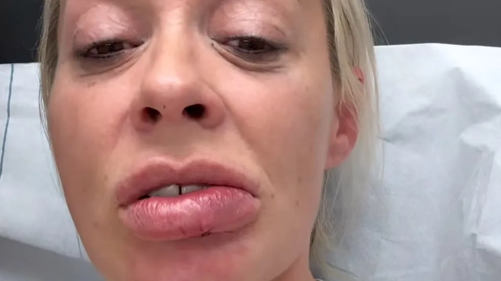 So stehts um die Lippe - Cora Schumacher meldet sich aus der Notaufnahme