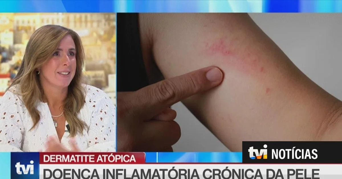 "Não é apenas pele seca". O seu filho terá dermatite utópica? Estes são os sinais a que deve estar atento