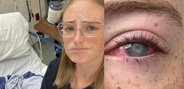 Ameba 'devoradora' de córneas: jovem perde visão após banhos com lentes