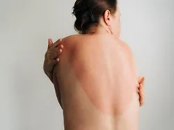 Krebsrisiko durch UV-Strahlung: Bereits ein einziger Sonnenbrand kann schwere Folgen haben