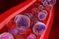 El cáncer hematológico será el quinto más frecuente en España el próximo año con casi 28.700 nuevos diagnósticos