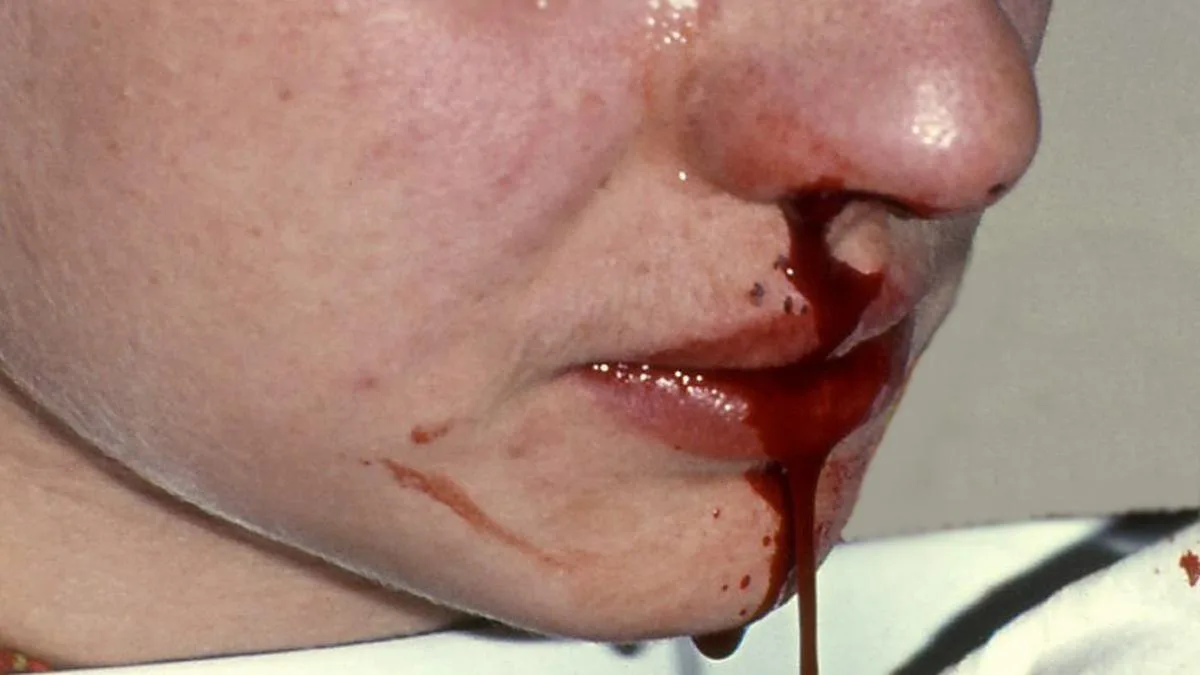 All you need to know about: nosebleeds