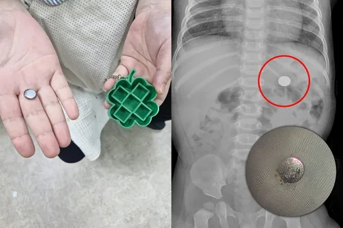 연휴에 리튬건전지 삼킨 9개월 아기…전북→부산 헬기 이송