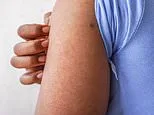The little-known condition that causes unsightly 'permanent goosebumps' - and up to 40 per cent of adults have it. This is exactly how to banish 'chicken skin' for good... and what NOT to do: DR SABIKA KARIM