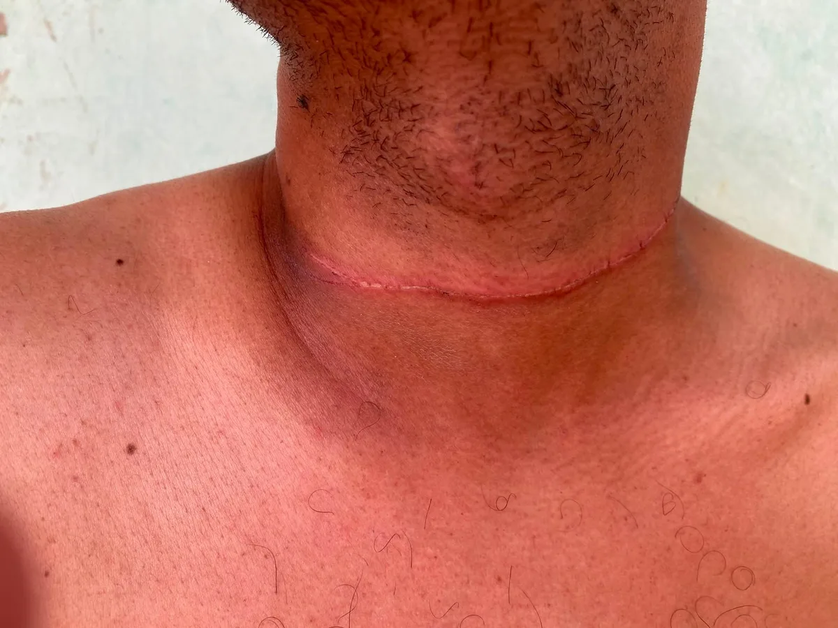 Motociclista sofre corte no pescoço por linha de cerol no Acre: 'Vi minha vida indo embora'