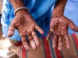 Deadly ancient disease is making a comeback in the US, experts warn... as they reveal the surprising reason why and how to protect yourself