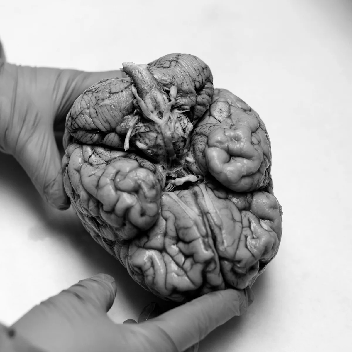 5 Takeaways on the Fallout From an Alarming C.T.E. Study