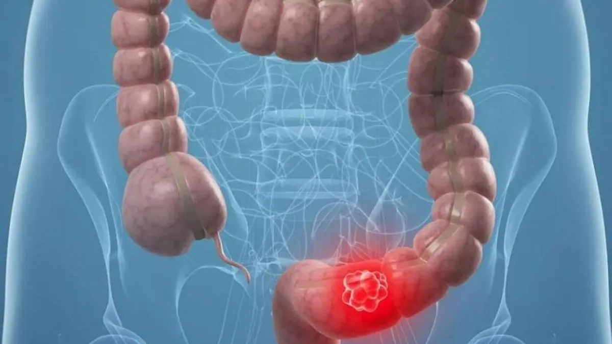 Un estudio aclara la 'paradoja de la obesidad' en el cáncer colorrectal: la clave estaba antes del diagnóstico