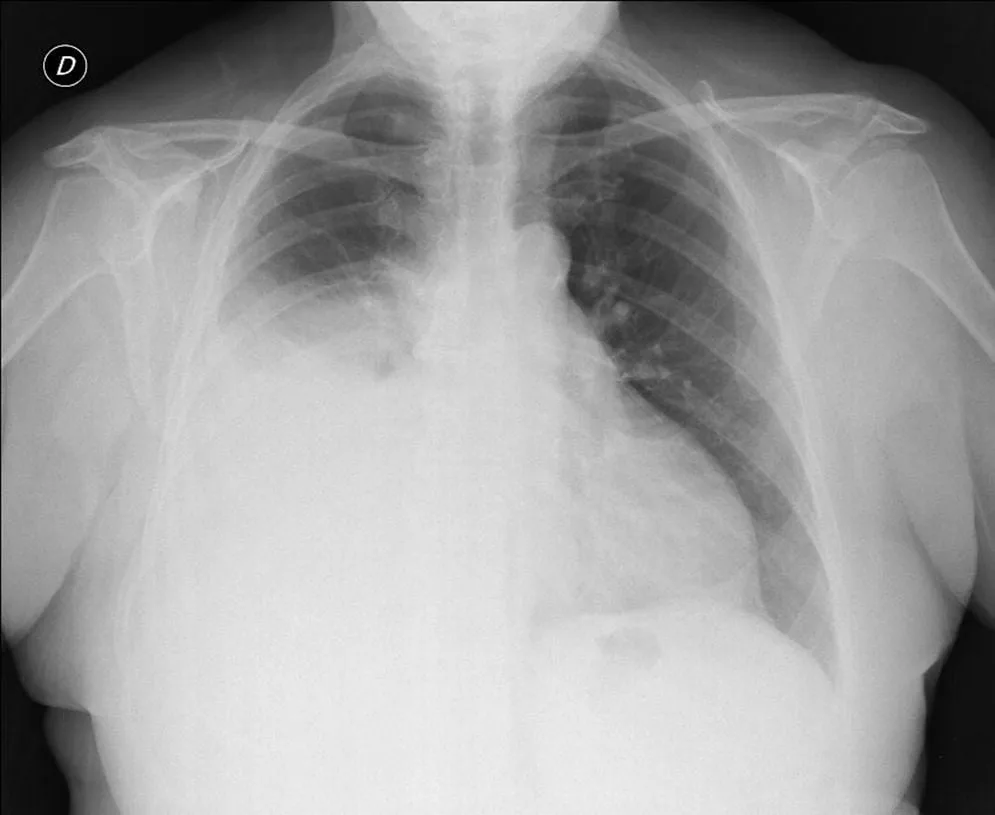 Mesotelioma pleural