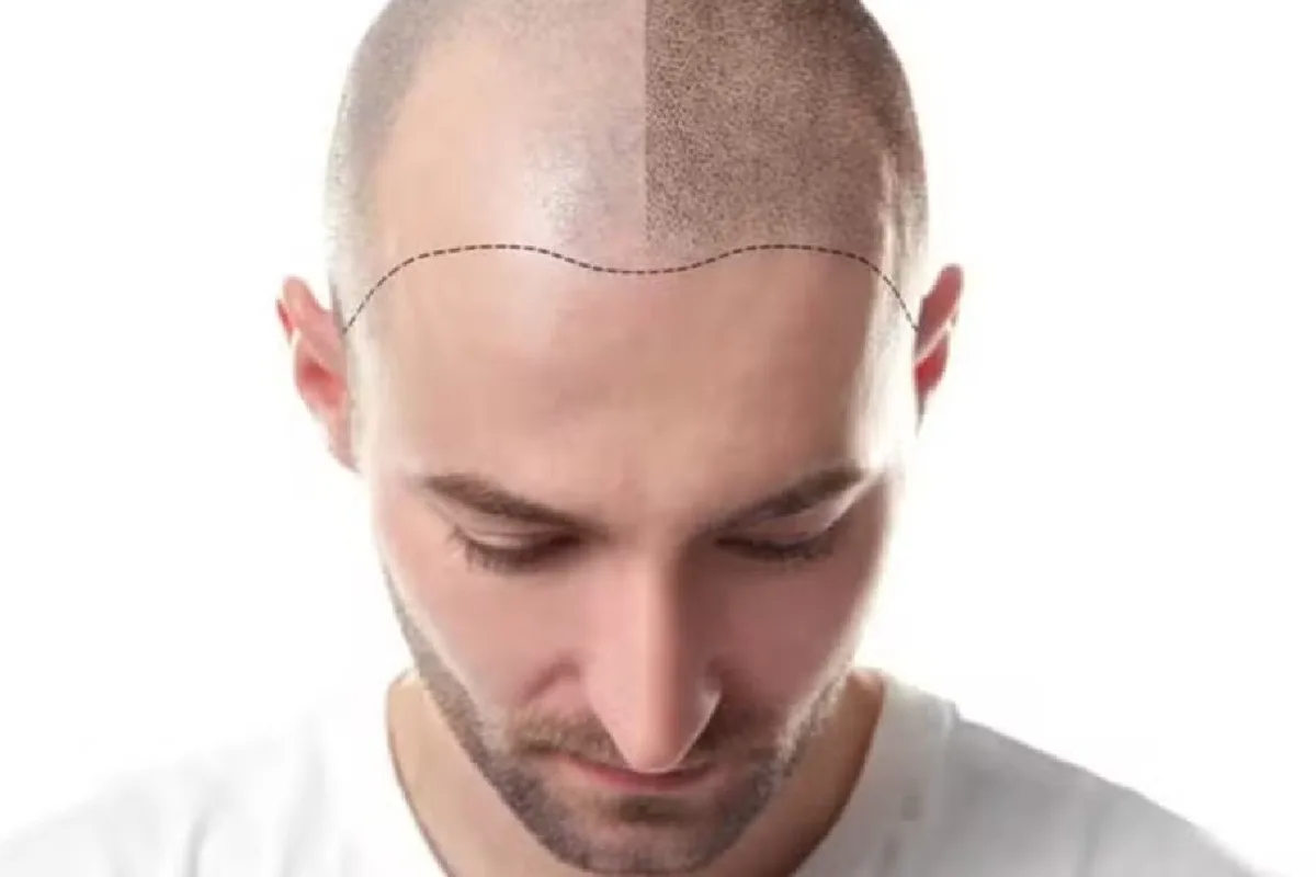 Micropigmentação capilar: conheça o procedimento para tatuar couro cabeludo em pessoas calvas