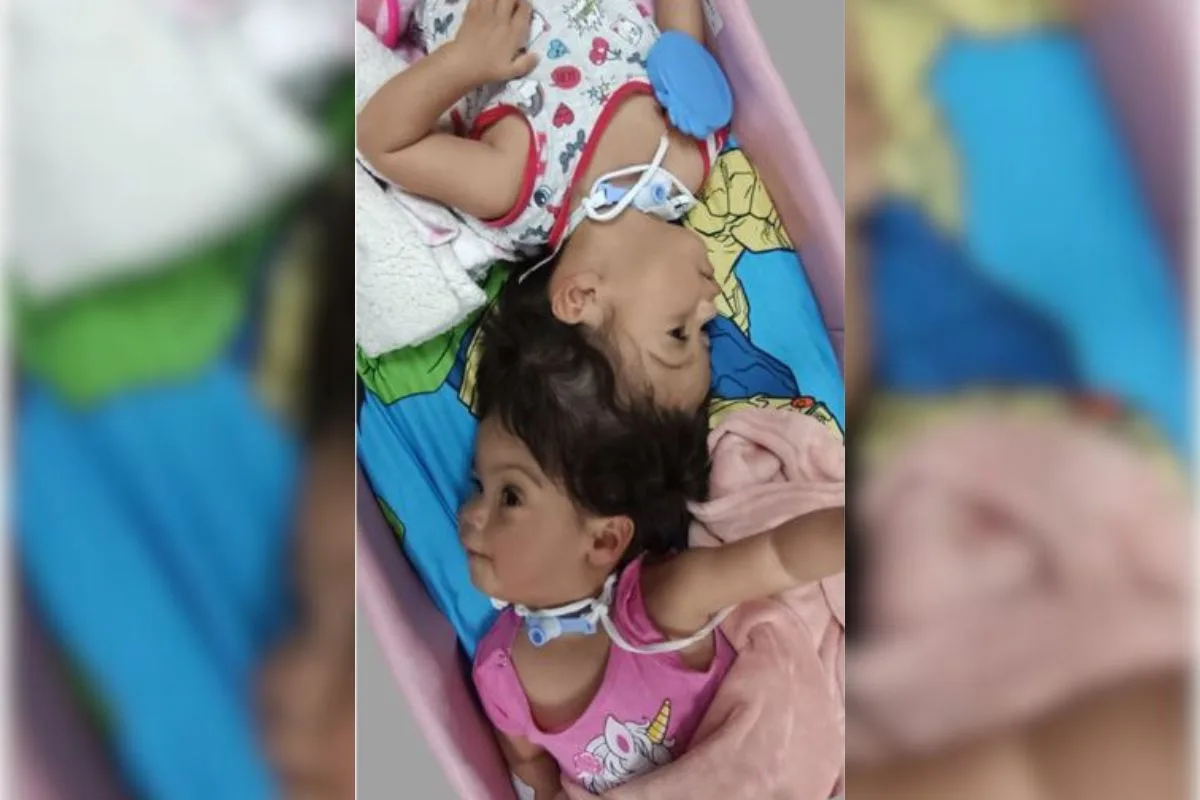 Gêmeas siamesas unidas pela cabeça morrem em cirurgia de separação
