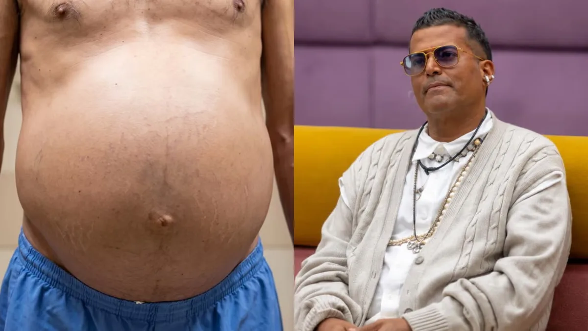 Ojos amarillos y abdomen inflamado: Detecta las 4 etapas del hígado graso antes de que sea irreversible