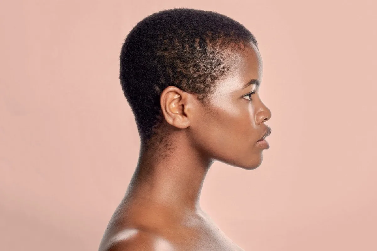 Dermatite seborreica pode provocar queda de cabelo em pessoas negras