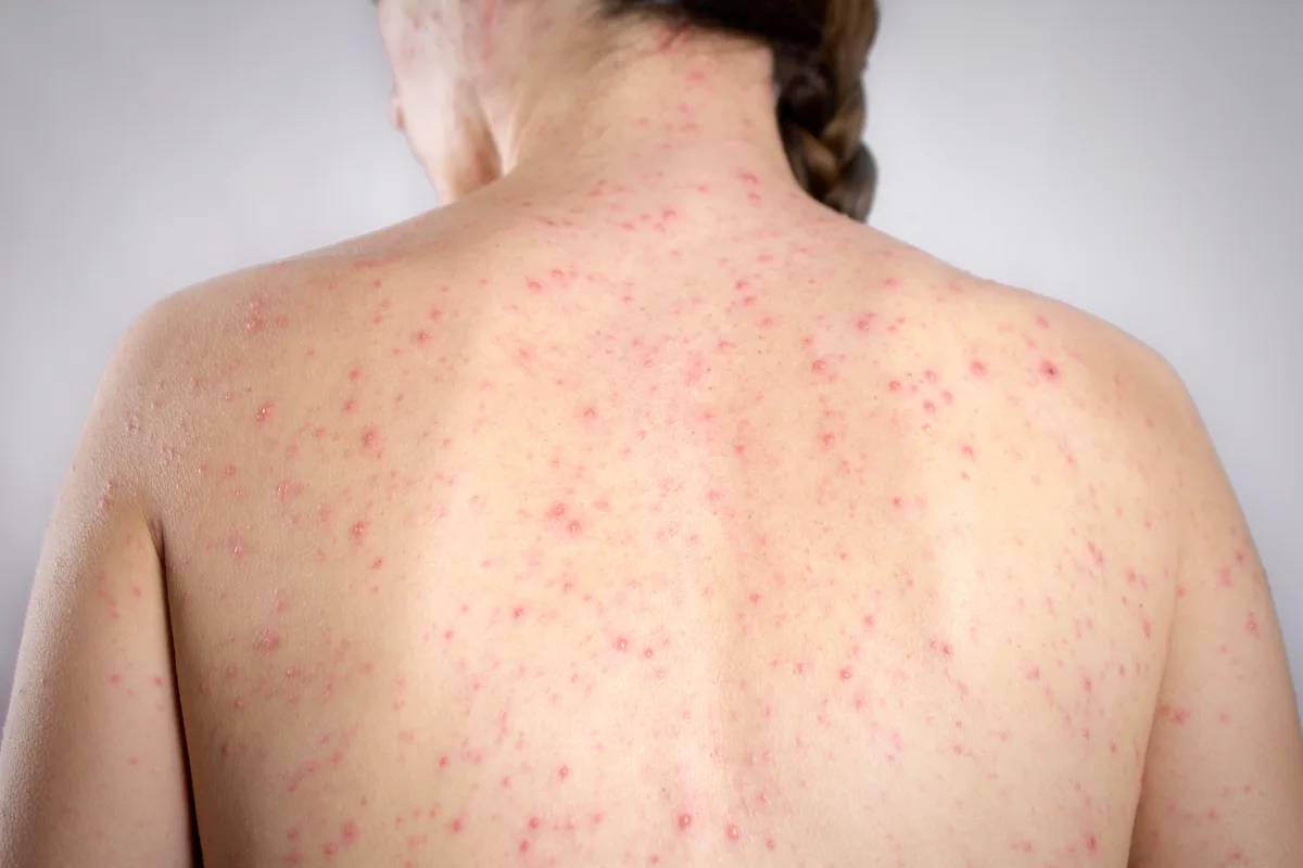 Sarampo: morte, inflamação no cérebro e infecções; entenda os riscos da doença que pode ser evitada com vacinação